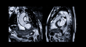 Cardiac MRI offered at RIS in Lakeland, FL