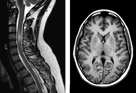 Spine and Brain MRI