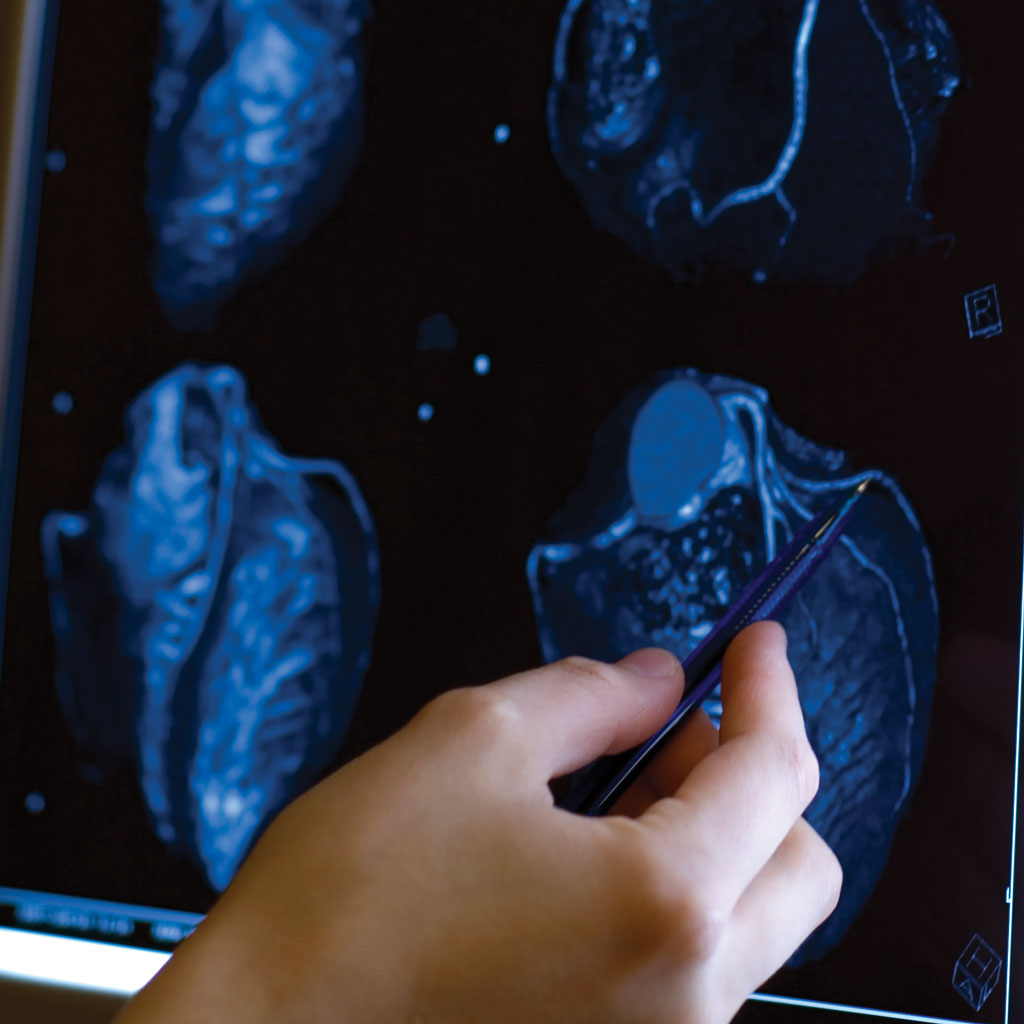 Coronary CT Angiography